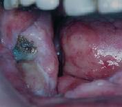 歯肉ガン　症例写真