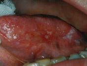 舌ガン　症例写真